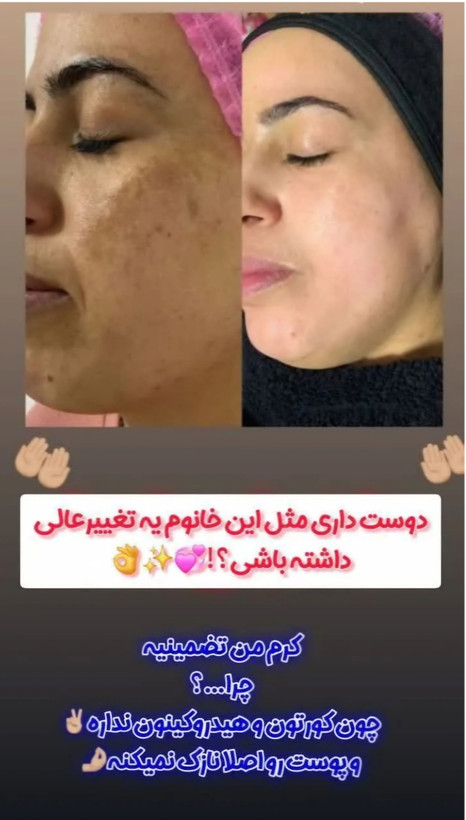 کرم بیوممتیک ضد لک لاکچری کوین